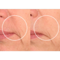 SiO Beauty Super Liplift | Smile & Lip Anti-Wrinkle Patches 4 Week Supply